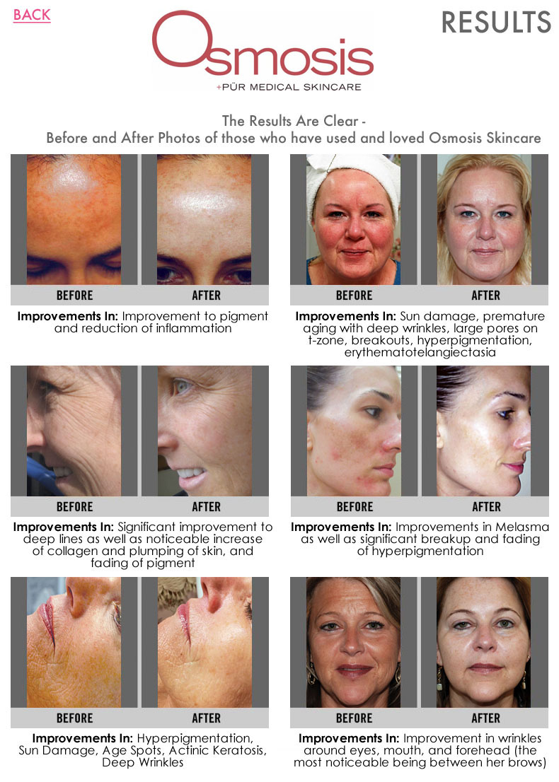 Osmosis Skincare Results | Skincare by Alana